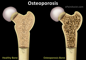 osteoporoza