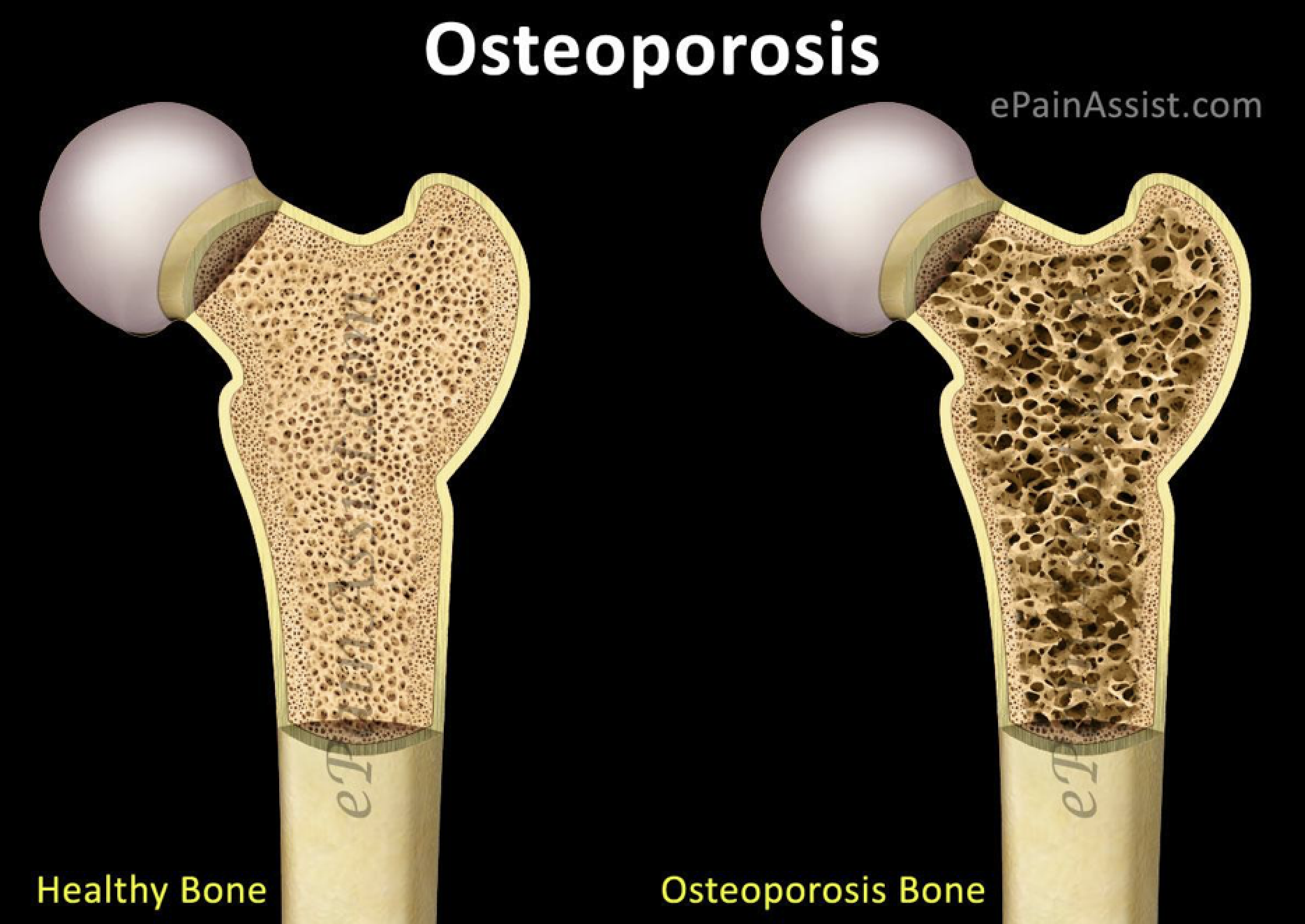 osteoporoza