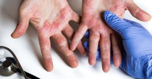 dermatita de contact